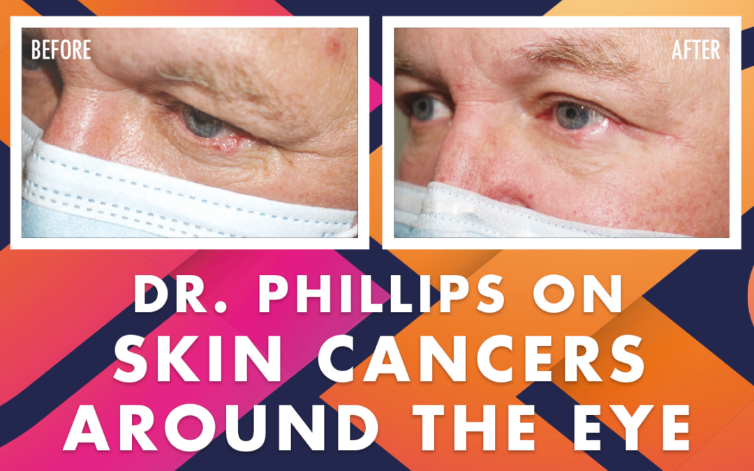 Skin Cancers Around the Eye